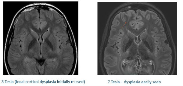 Partner investment in 7 Tesla MRI impacts Illinois research, patient care